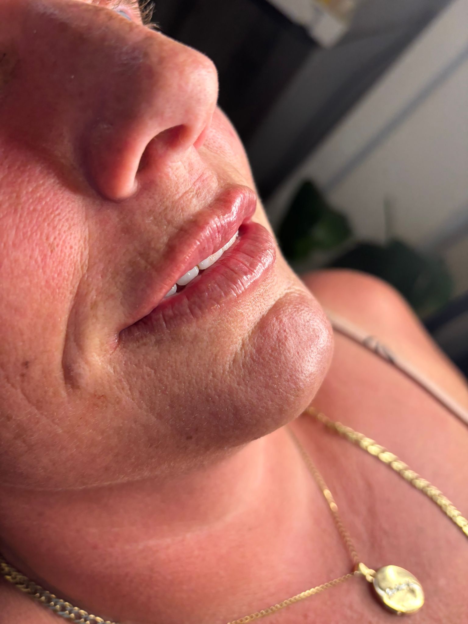 Gummy smile treatment