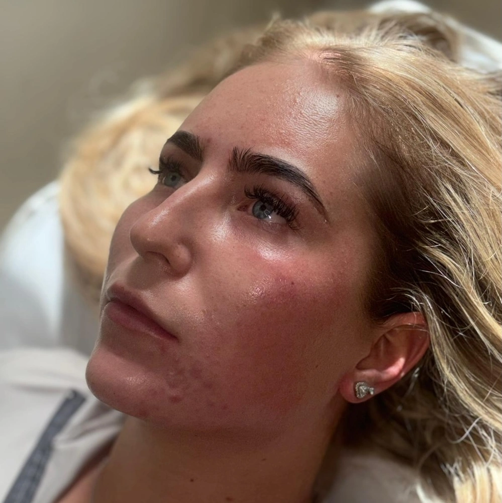 Cheek fillers