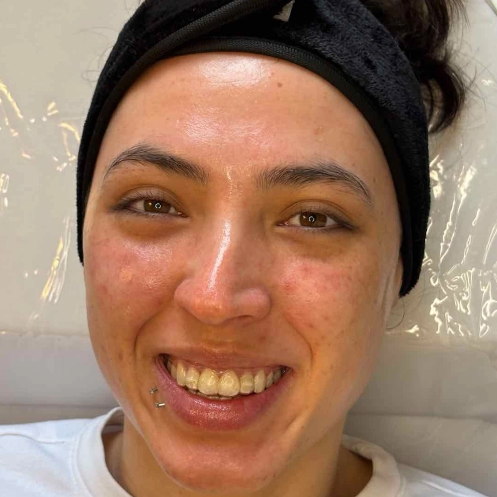 Chemical peel