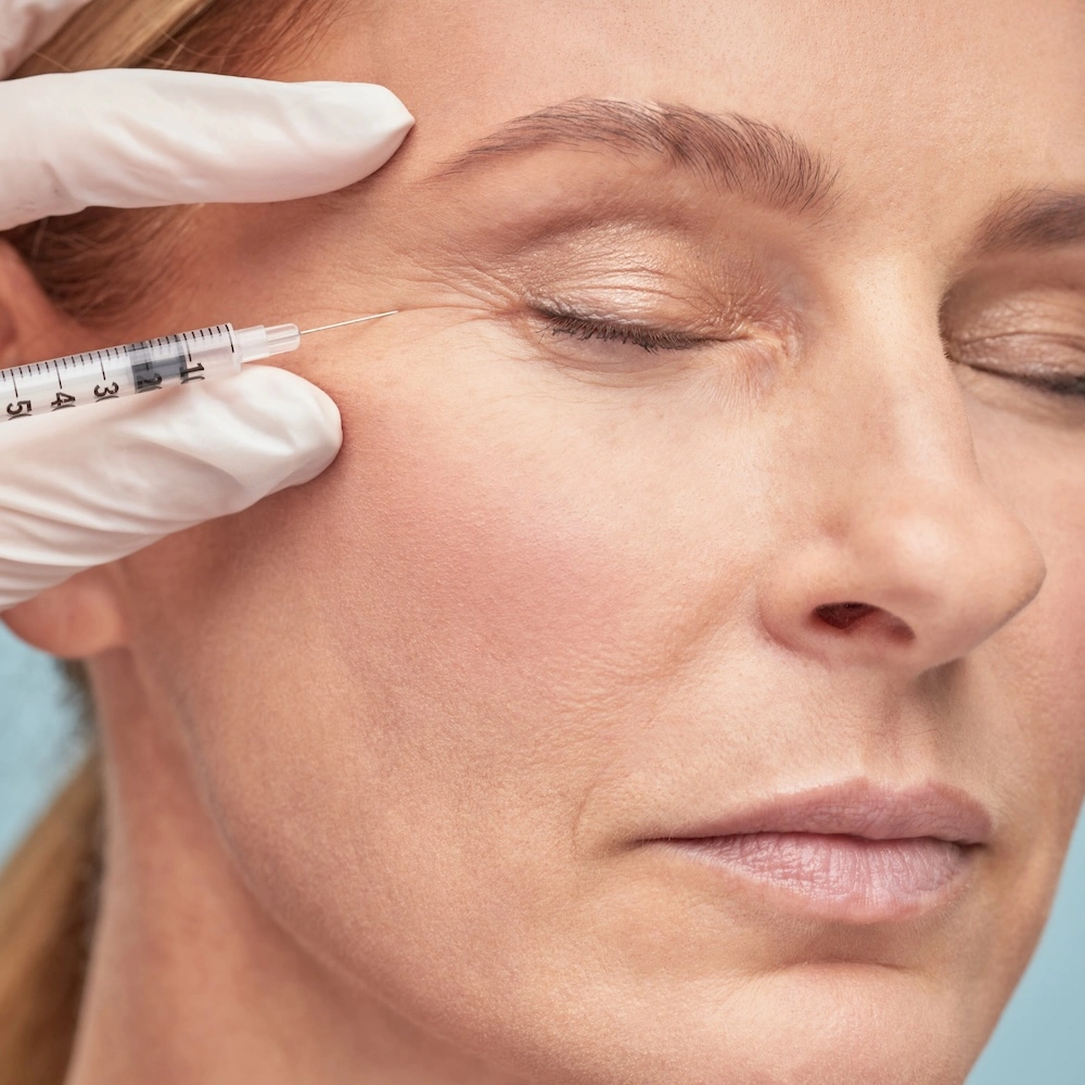 Crows feet treatment