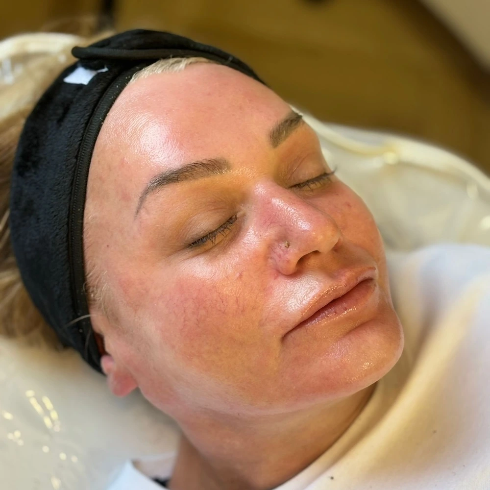 Dermaplaning
