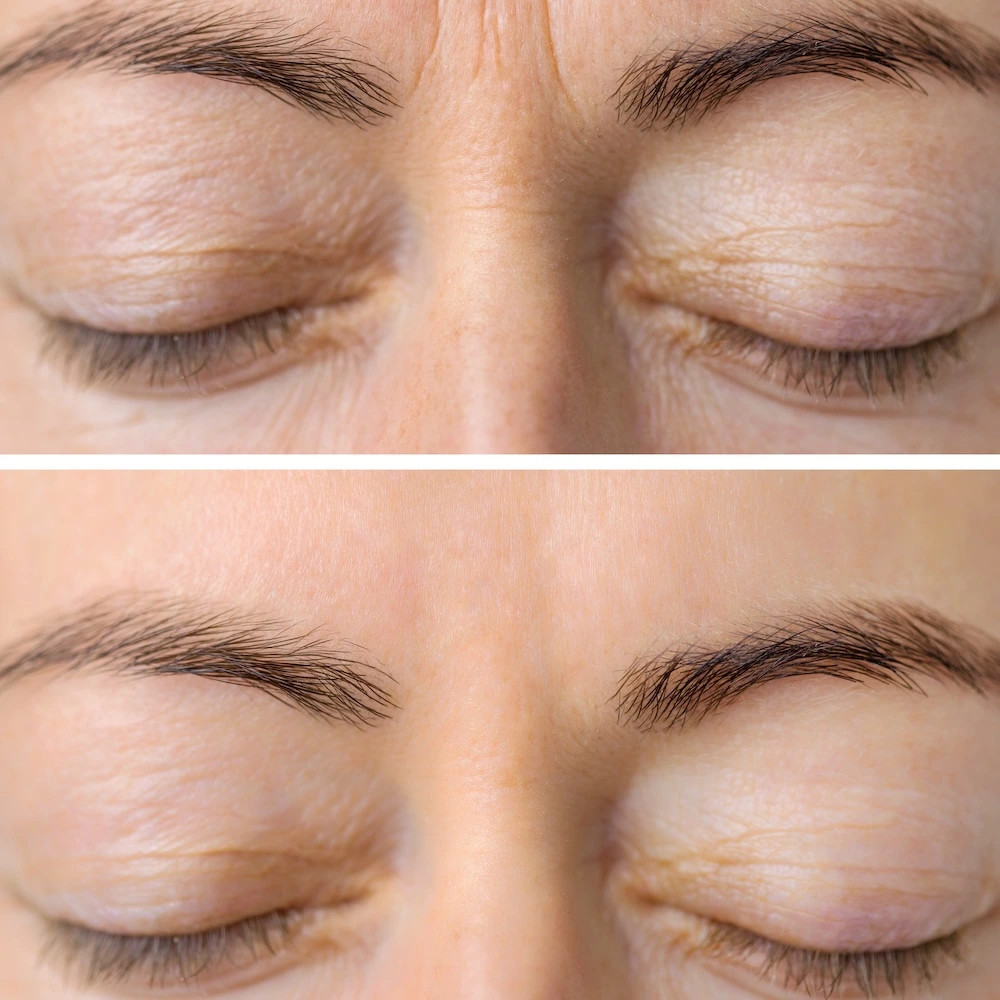 Frown Line Treatment