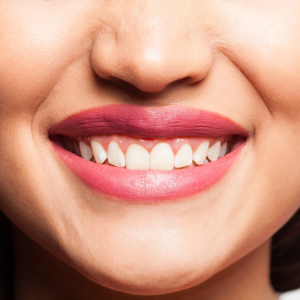 Gummy smile treatment