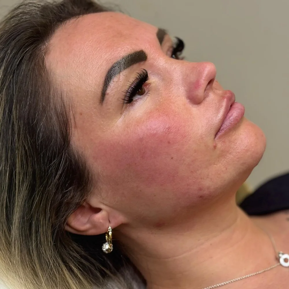 Jaw fillers
