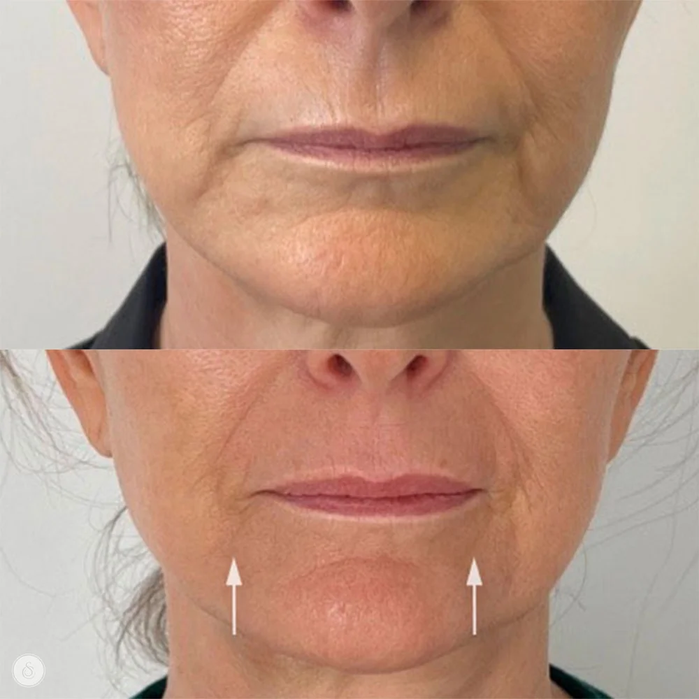 Marionette line treatment