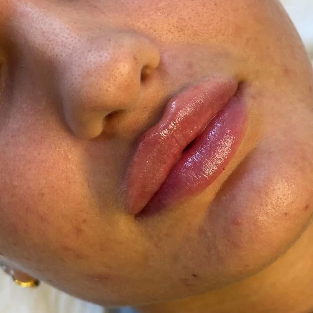Russian lip fillers