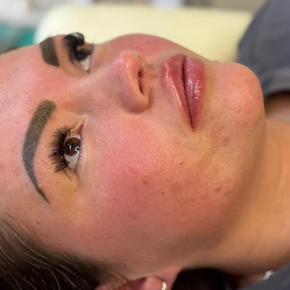 Russian lip fillers