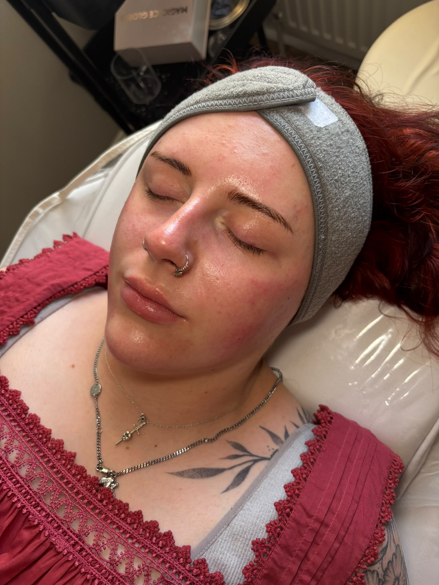 Chemical peel