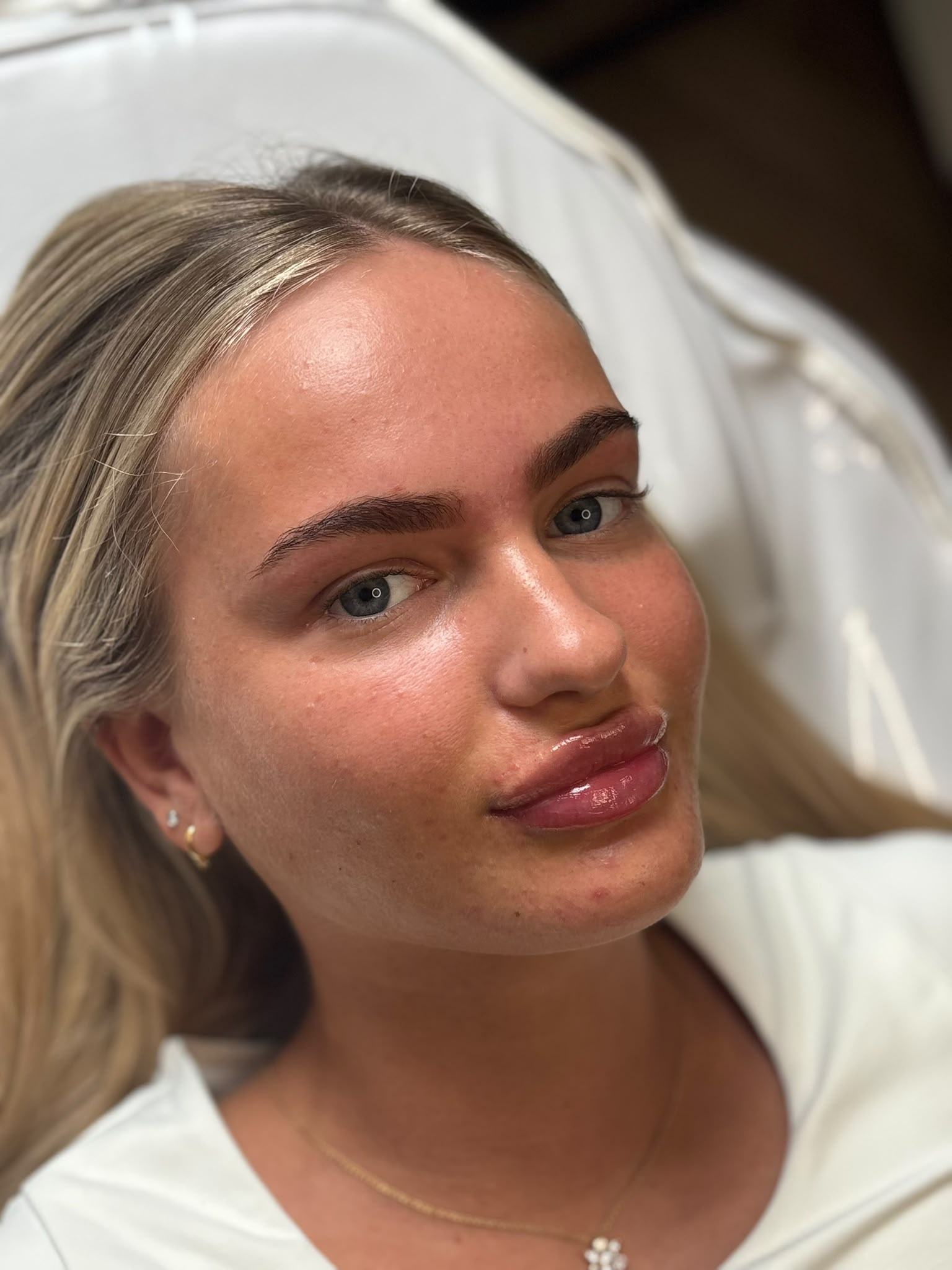 Russian lip fillers